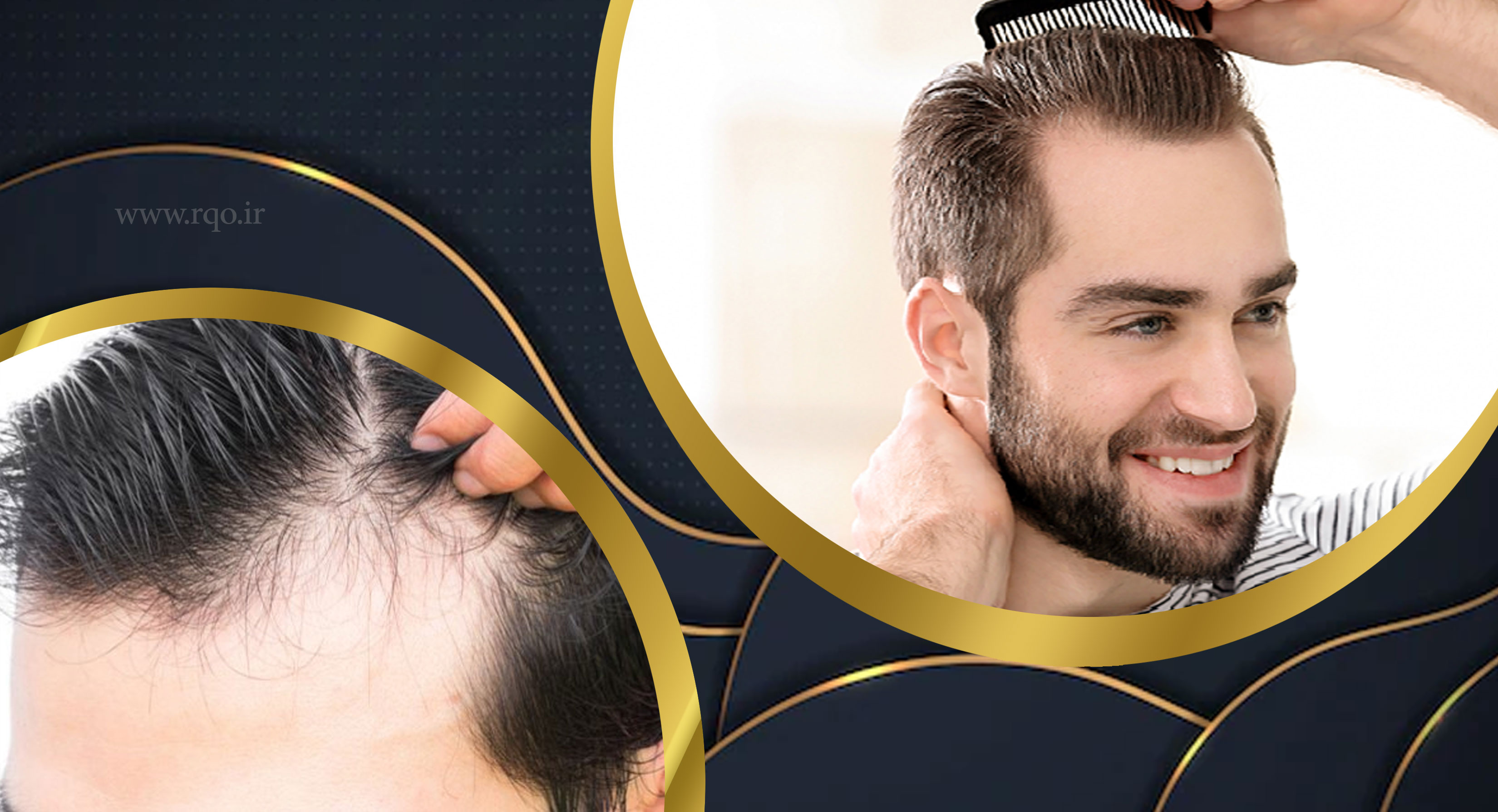 بهترین خدمات کاشت مو در ساری